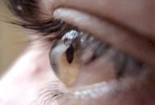 این علائم اخطار جدی بودن ابتلا به قوز قرنیه است