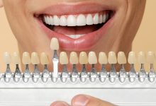 بهترین برند لمینت دندان کدام است؟